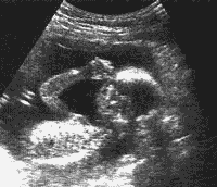 As ondas do ultrasom são transmitidas para dentro do abdômen, onde elas se refletem a partir da superfície do feto.