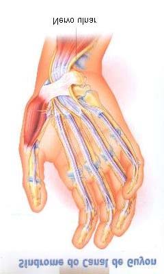 A sigla LER - Lesões por Esforços Repetitivos - foi criada para identificar um conjunto de doenças que atingem músculos, tendões e articulações dos membros superiores (dedos, mãos, punhos, antebraços