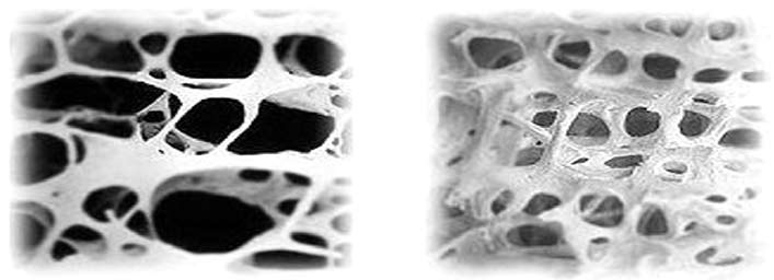 Osso com Osteoporose Osso normal Como a osteoporose é uma doença assintomática, (não provoca dores ou dá outros sinais) geralmente é diagnosticada tardiamente, muitas vezes quando a pessoa idosa