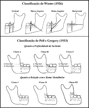 III (Figura 1) (5). Quanto à Profundidade de Inclusão Ilustrações retiradas do Livro Colombini 20. Figura 1 - Classificações de Winter e de Pell e Gregory.