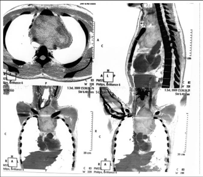 Rhabdomyosarcomas of the anterior mediastinum: Report of four cases unassociated with germ