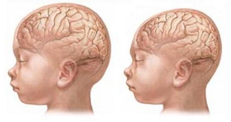 A microcefalia carateriza-se por um diâmetro cefálico com 2 ou mais desvios padrões abaixo da média. Entretanto, podem-se encontrar cérebros dentro desses padrões exibindo um QI normal.