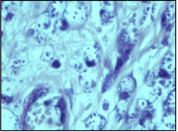 38 2.3.3. Histometria e imuno-histoquímica Análise de formas amastigotas de pata e linfonodo Na histometria foram analisadas de maneira quantitativa e semi-quantitativa a resposta inflamatória e a