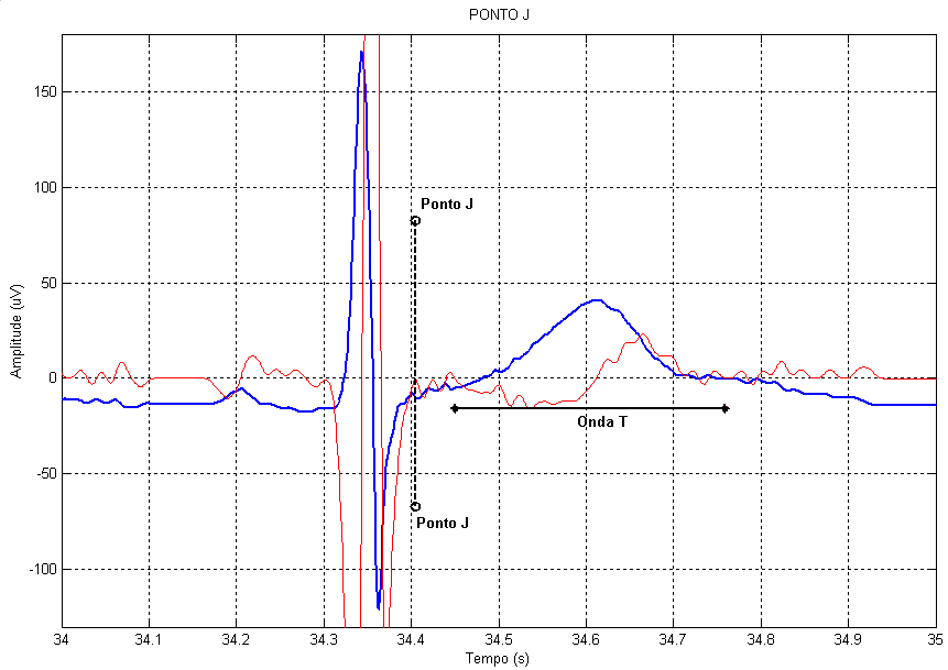 Metodologia 79 Figura 4.12: Ilustração de batimentos de ECG (traço largo, azul) juntamente com o respectivo traçado dos coeficientes da transformada wavelet na escala 2 3 (traço fino, em vermelho).