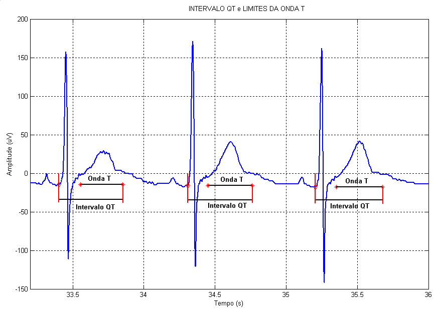 Resultados obtidos 89 Figura 5.3: Ilustração de batimentos de ECG (traço largo, azul) juntamente com o respectivo traçado dos coeficientes da transformada wavelet na escala 2 6 (traço fino, em verde).