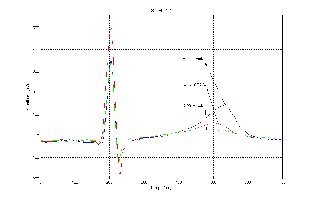 Resultados obtidos 103 Figura 5.21: Batimentos registrados a diferentes valores de glicemia (Indivíduo C). A Tabela 5.