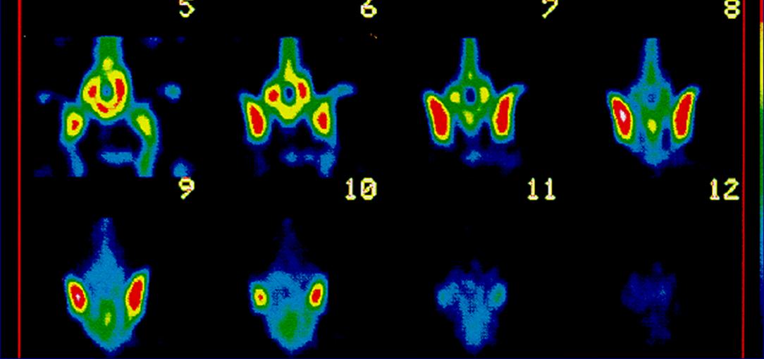 Cintilografia e SPECT ósseo com MDP- 99m Tc (inserido em 2010