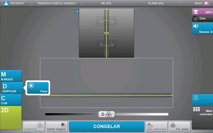 CAPÍTULO 4 Doppler As imagens de Doppler são uma exibição de um espectro de velocidades de fluxo ao longo do tempo. A amplitude do sinal é indicada como uma sombra de cinza.