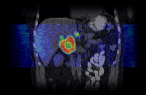 Reconstrução de imagem o Métodos analíticos o Métodos Iterativos g(s, θ) número de cintilações detectadas na posição s ao longo do detector, com angulação θ f(x,y) número de fotões emitidos a partir