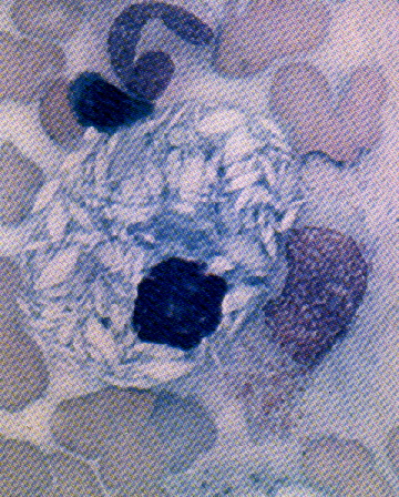ALTERAÇÕES CITOPLASMÁTICAS - CÉLULA DE GAUCHER A células de Gaucher está associada a Doença de Gaucher.