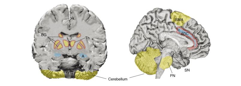 As co-morbilidades neurológicas do autismo são um mecanismo de confusão para a compreensão da neuroanatomia cerebral.