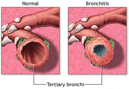 INTRODUÇÃO DOENÇA PULMONAR OBSTRUTIVA CRÓNICA (DPOC) DOENÇA RESPIRATÓRIA CRÓNICA CARACTERIZADA PELA