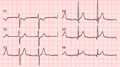 Figura 2: Traçado eletrocardiográfico do adolescente do