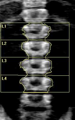 7 kg Age: 11 Referring Physician: UEFA Scan Information: Scan Date: 03 March 2014 ID: A0303140C Scan Type: e Lumbar Spine Analysis: 03 March 2014 18:55 Version 13.