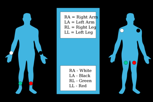 CAPÍTULO 2 Norma AHA (Quality Certification Services): Figura 2.6 Localização das 4 derivações no corpo humano (Norma AHA).