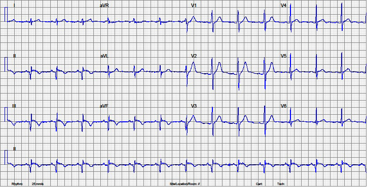 Santos e cols. Drogas anabolizantes e infarto do miocárdio Relato de Caso Figura 1 ECG na admissão com sinais de infarto das paredes inferior e posterior em fase subaguda. melhora analítica.