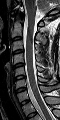 Coluna cervical Composta por 7 vértebras, faz a junção