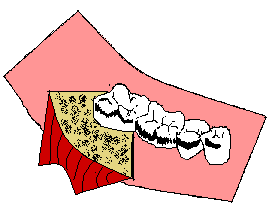 INCISÃO DE LOTTER; incisão horizontal mucoperiostal na crista do rebordo alveolar até a distal do segundo molar, e uma segunda incisão horizontal mucosa dividindo o retalho a partir da distal do