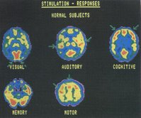 MAPEANDO FUNDAMENTOS DO CONSTRUCTO NEUROMARKETING COM PROFISSIONAIS DE EMPRESAS DE PUBLICIDADE cérebro e consiste na aplicação de 2-DG (2-desoxiglicose) radioativa na artéria carótida do paciente.