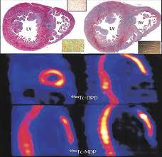 PAPEL DA IMAGEM NUCLEAR Pode sugerir diagnóstico de miocardiopatia dilatada na presença de VE dilatado, hipocinético, sem isquemia indutível ou defeitos fixos SARCOIDOSE Acumulação de galio-67-