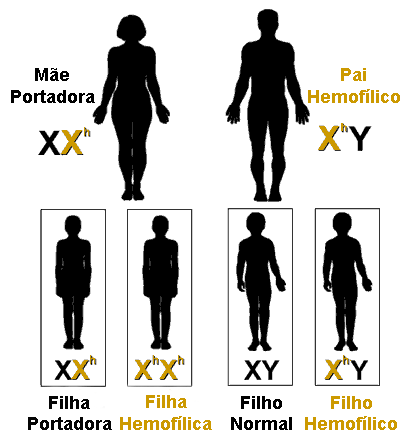 d) X H Y homem normal e) X h Y homem hemofílico Apostila ENEM em 100 Dias Observe o exemplo abaixo que demonstra a possibilidade de nascimento de filhos e filhas hemofílicos: Daltonismo: Má formação