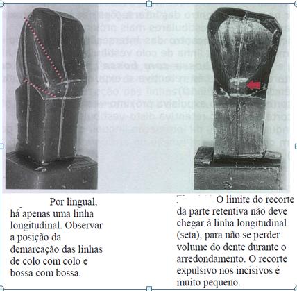 FIGURA 16b i) Face lingual: Remover três porções de cera (uma próximo à mesial, outra próximo à distal a