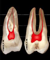 Anatomia Dental Interna Molares superiores Segundo Molar
