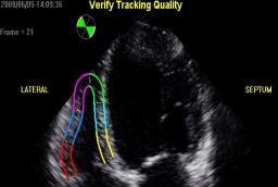 Mestrado em Tecnologia de Diagnóstico e Intervenção Cardiovascular - Relatório de Actividades de Estágio Figura 2.