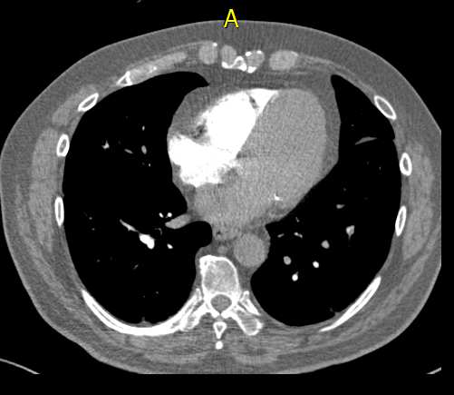 horas) Chandra. Ann Intern Med 2009;5:80-90.