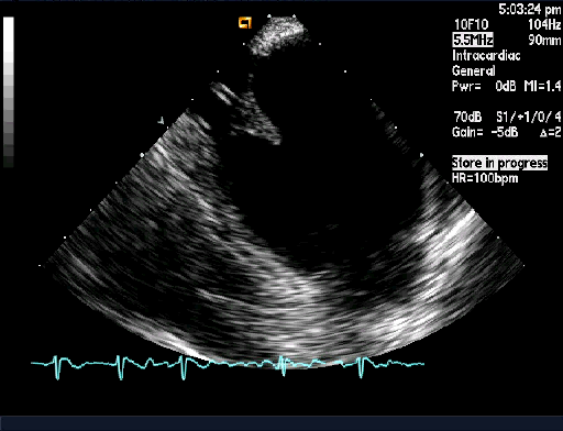Figura 2 Punção transeptal visualizada pelo ecocardiograma intracardíaco (ICE).