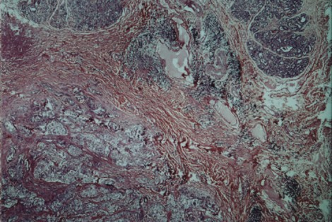 A proliferação de tecido conjuntivo associado às neoplasias malignas equivaleu a 40,70% dos casos analisados (Figura 11). Figura 11.