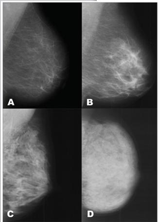 Também são descritos quatro padrões: mamas lipossubstituídas (menos de 25% de tecido fibroglandular); mamas parcialmente lipossubstituídas (25 a 50% de