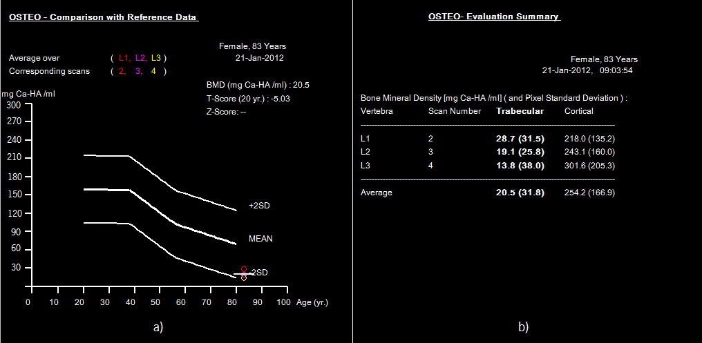 18 - Avaliação Osteo TC final do paciente 3: a) resultados estatísticos e representação gráfica; b) valores da densidade trabecular e cortical