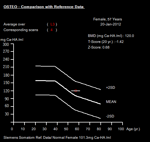 Figura 4.33 - Resultados estatísticos, com representação gráfica, da vértebra L3. A análise final, sendo esta a utilizada para diagnóstico e monitorização osteoporótica, encontra-se na Figura 4.34.