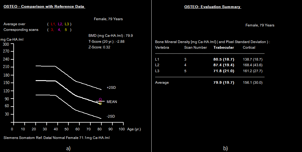 Capítulo 4 estado osteoporótico, isto é, a menor BMD trabecular (73 mg Ca-HA/ml).