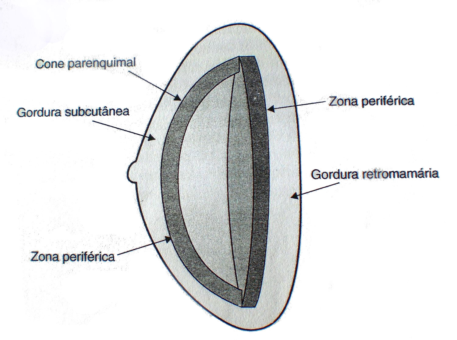 6 incidência do câncer (KOPANS, 2000). Figura 2.2: Representação esquemática da anatomia básica da mama destacando o ducto terminal e a unidade lobular do ducto terminal (ULDT).
