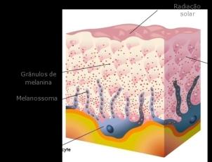 várias vezes à ação do Sol. Epidérmico: melanina nas camadas basais e suprabasais da epiderme. Dérmico: macrófagos com melanina na derme. Misto: os dois tipos podem em uma mesma área.