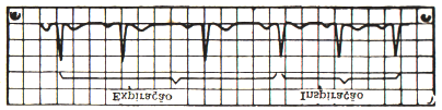 II- ARRITMIA SINUSAL Na arritmia sinusal, o traçado é de forma normal, porém arrítmico.