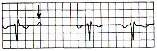 Por vezes, podem somar-se outras anomalias: 1-Forma normal ou invertida ou difásica da onda P: quanto mais acentuada a anomalia, tanto mais o ponto de partida da excitação auricular está distante do