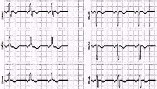 Infarto Anterior do Miocárdio. Observar acidente QS em V1 e V2, e QR em V3 e V4 (sinais de necrose). Não há sinais de lesão aguda e nem de isquemia). Trata-se de infarto não muito recente.