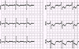 Infarto Agudo Lateral do Miocárdio. Supradesnivelamento de ST (sinal de lesão aguda) em D1, avl, V4, V5 e V6. Acidente QS em D1, avl, V5 e V6 (Sinal de necrose). Não há sinais de isquemia.