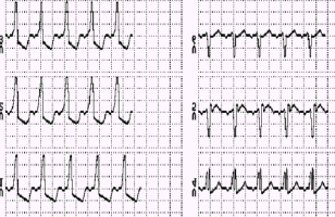 Infarto Agudo Anterior do Miocárdio, com Isquemia Lateral. T coronário em D1, avl, V5 e V6 (T invertido, simétrico e pontiagudo) sinal de isquemia.