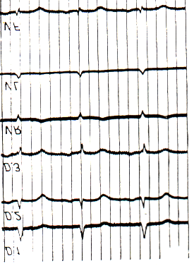 de freqüência variável, segundo os autores. Portanto, quando a anamnese leva ao diagnóstico de angina de peito, um ECG normal não deve abalar um diagnóstico clínico seguro.