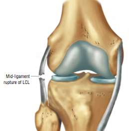 Ligamento colateral lateral / Canto postero-lateral Rupturas do LCL: Lesões do LCL são menos frequentes do