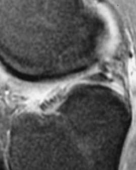 Rupturas meniscais Pitfalls Aspecto pontilhado da ponta anterior do menisco lateral Ocasionalmente