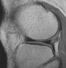 Meniscos: Estruturas fibrocartilagíneas e Forma de C + espessos à periferia pontas (forma triangular) + finos