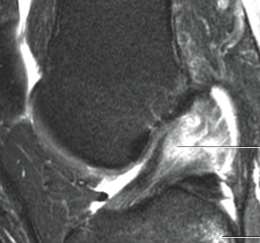 Ligamento cruzado anterior Classificação das Rupturas (American Medical Association Ligament injury classification system) Grau I lesão sem