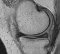 Rupturas meniscais Critérios: Morfologia anormal Hipersinal contactando a superfície articular