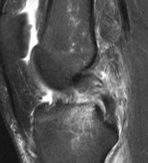 Ligamento cruzado anterior Lesões ósseas Contusões ósseas no côndilo femoral lateral e pratos tibiais posteriores