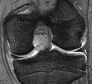 Ligamento cruzado posterior RM: Intersticiais